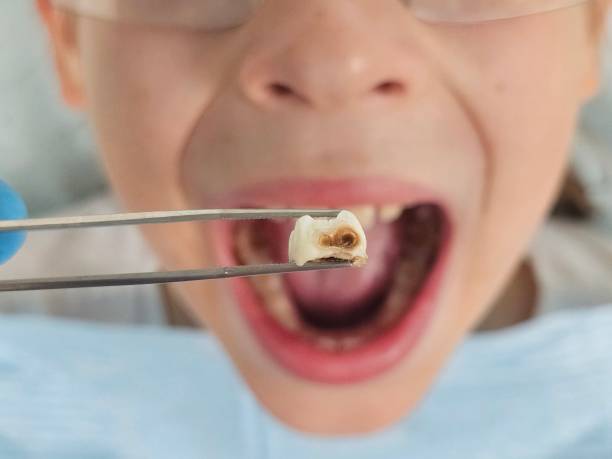 Best Emergency Gum Treatment in League City, TX